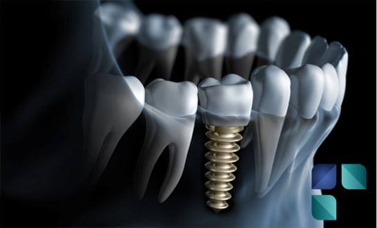 Implante Dentário em Curitiba