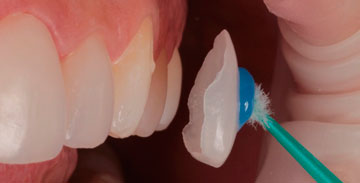faceta-dental